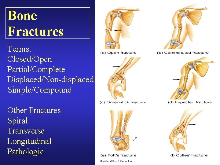 Bone Fractures Terms: Closed/Open Partial/Complete Displaced/Non-displaced Simple/Compound Other Fractures: Spiral Transverse Longitudinal Pathologic Bone Fractures Terms: Closed/Open Partial/Complete Displaced/Non-displaced Simple/Compound Other Fractures: Spiral Transverse Longitudinal Pathologic