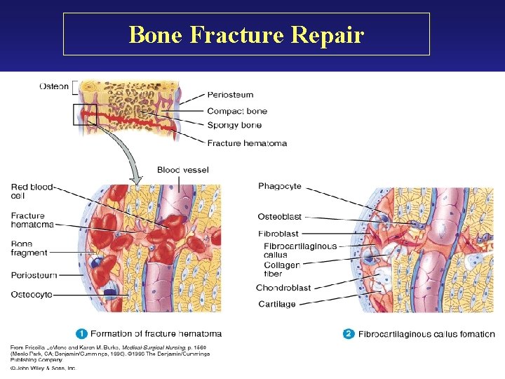 Bone Fracture Repair Bone Fracture Repair