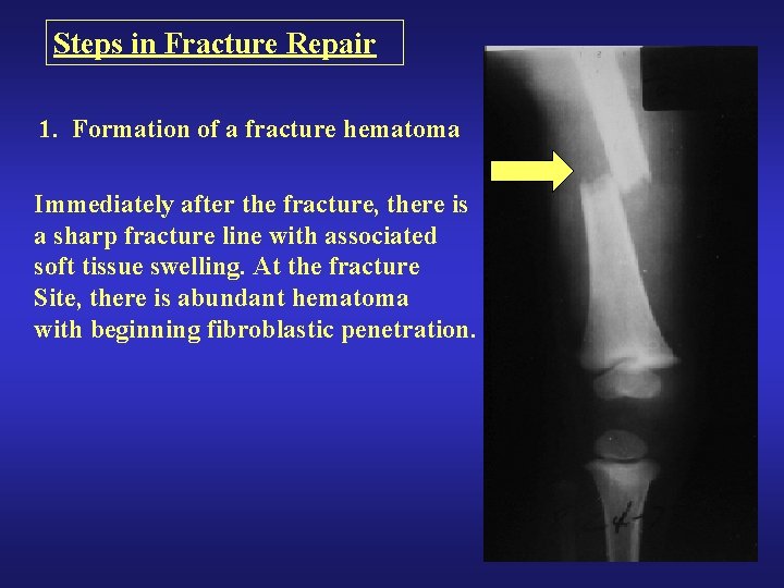 Steps in Fracture Repair 1. Formation of a fracture hematoma Immediately after the fracture, Steps in Fracture Repair 1. Formation of a fracture hematoma Immediately after the fracture,