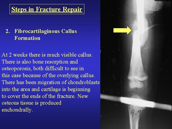 Steps in Fracture Repair 2. Fibrocartilaginous Callus Formation At 2 weeks there is much Steps in Fracture Repair 2. Fibrocartilaginous Callus Formation At 2 weeks there is much