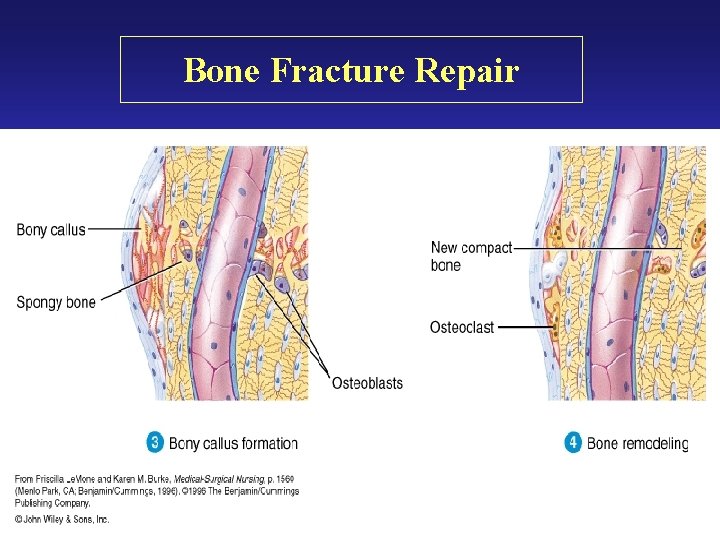 Bone Fracture Repair Bone Fracture Repair