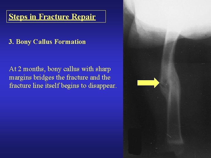 Steps in Fracture Repair 3. Bony Callus Formation At 2 months, bony callus with Steps in Fracture Repair 3. Bony Callus Formation At 2 months, bony callus with