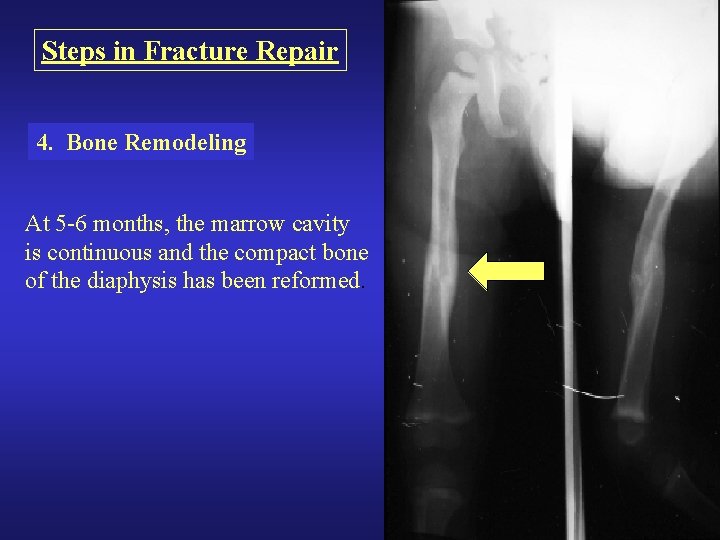 Steps in Fracture Repair 4. Bone Remodeling At 5 -6 months, the marrow cavity Steps in Fracture Repair 4. Bone Remodeling At 5 -6 months, the marrow cavity