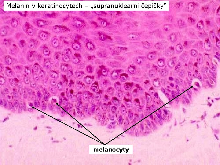 Melanin v keratinocytech – „supranukleární čepičky“ melanocyty 