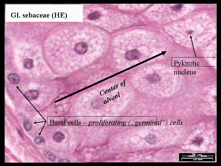  Gl. sebaceae (HE) Pyknotic nucleus f o r te n e C ol