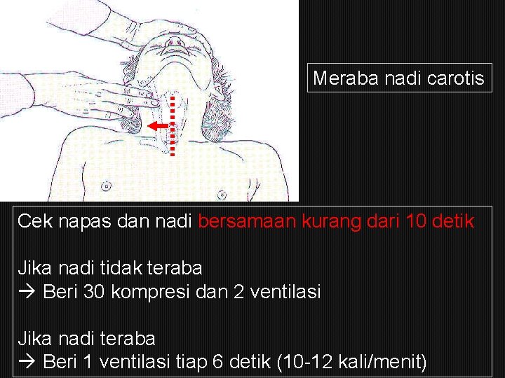 Meraba nadi carotis Cek napas dan nadi bersamaan kurang dari 10 detik Jika nadi