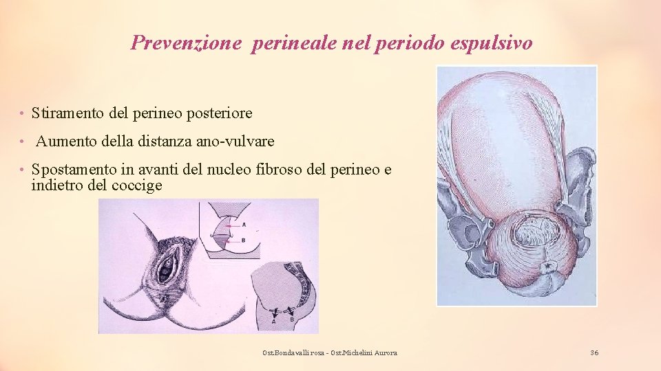 Prevenzione perineale nel periodo espulsivo • Stiramento del perineo posteriore • Aumento della distanza