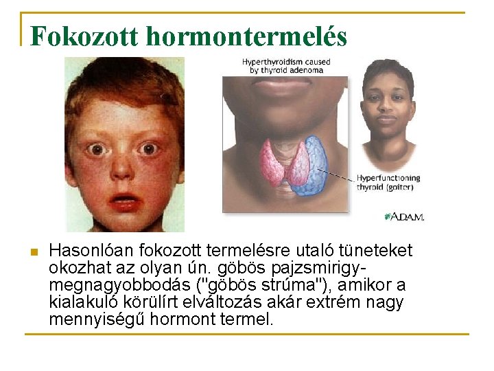 Fokozott hormontermelés n Hasonlóan fokozott termelésre utaló tüneteket okozhat az olyan ún. göbös pajzsmirigymegnagyobbodás