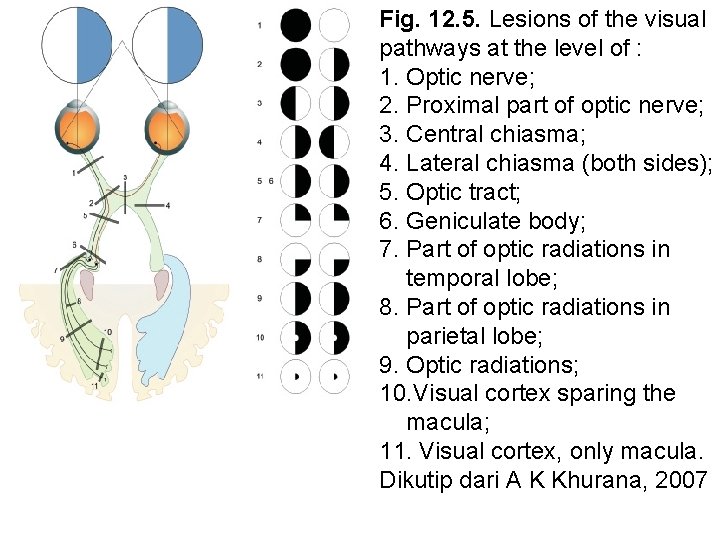 Fig. 12. 5. Lesions of the visual pathways at the level of : 1.