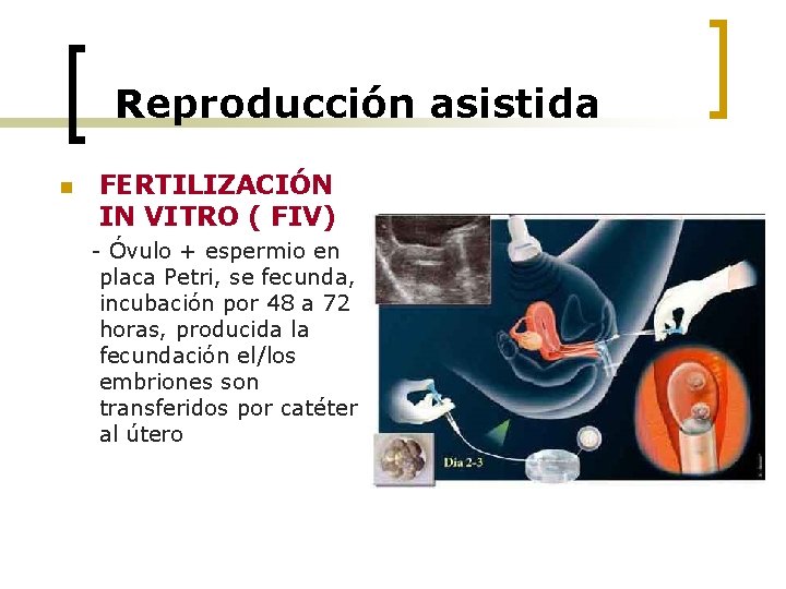 Reproducción asistida n FERTILIZACIÓN IN VITRO ( FIV) - Óvulo + espermio en placa