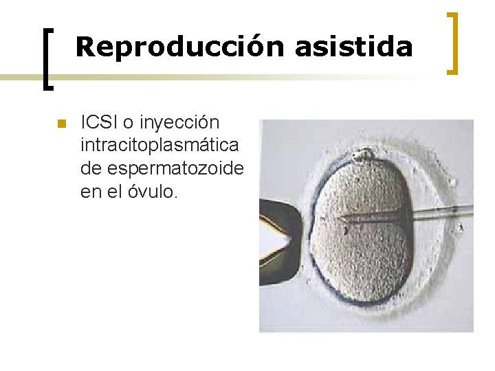 Reproducción asistida n ICSI o inyección intracitoplasmática de espermatozoide en el óvulo. 