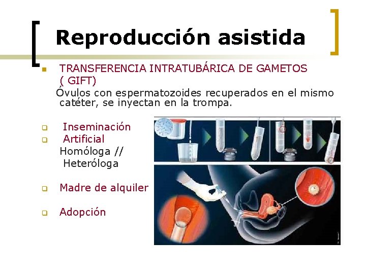 Reproducción asistida n q q TRANSFERENCIA INTRATUBÁRICA DE GAMETOS ( GIFT) Óvulos con espermatozoides