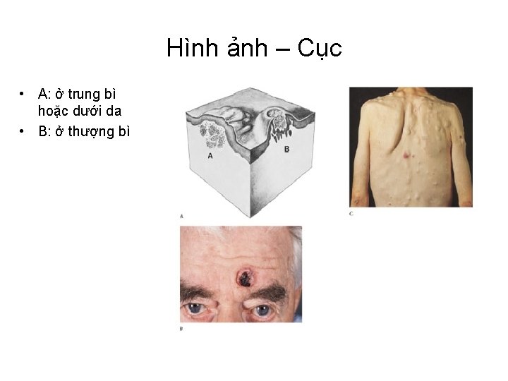 Hình ảnh – Cục • A: ở trung bì hoặc dưới da • B: