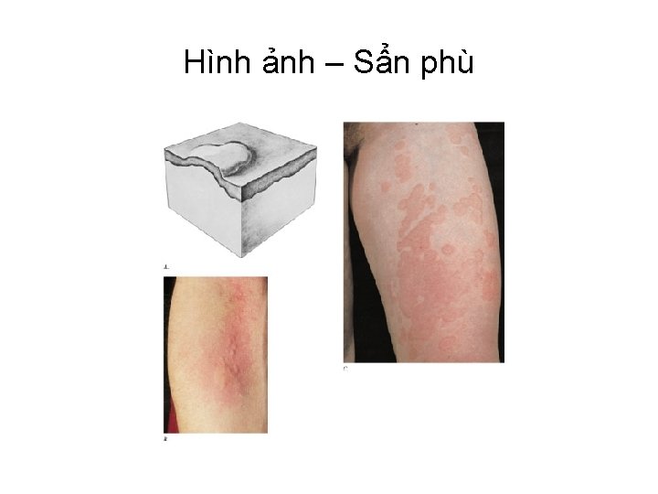 Hình ảnh – Sẩn phù 