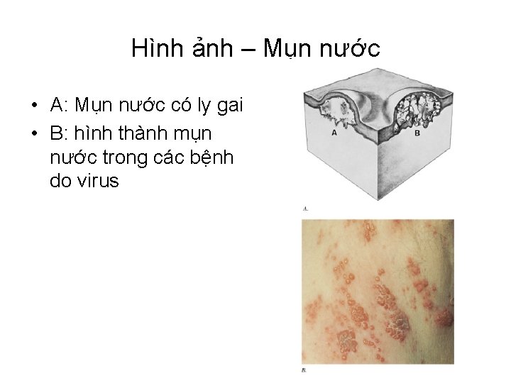 Hình ảnh – Mụn nước • A: Mụn nước có ly gai • B: