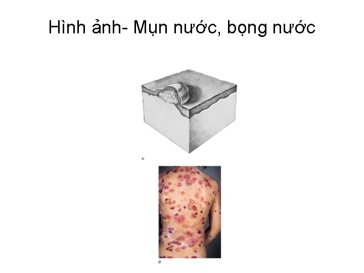 Hình ảnh- Mụn nước, bọng nước 