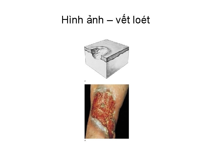 Hình ảnh – vết loét 