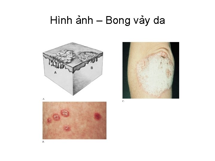 Hình ảnh – Bong vảy da 