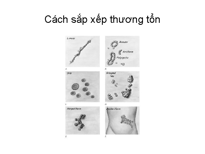 Cách sắp xếp thương tổn 