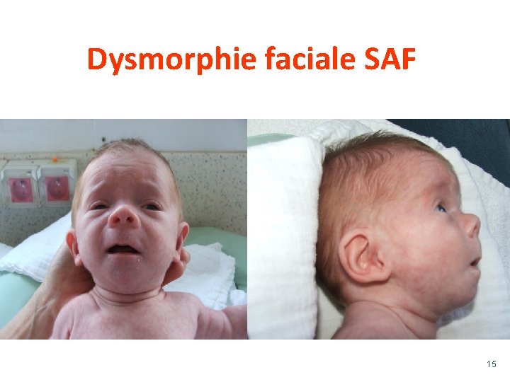 Dysmorphie faciale SAF 15 