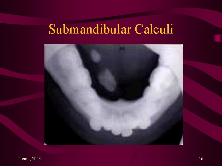 Submandibular Calculi June 4, 2003 16 