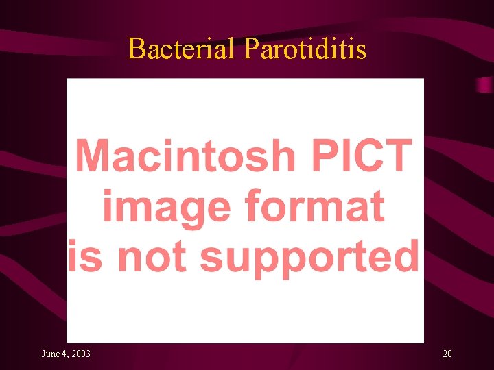 Bacterial Parotiditis June 4, 2003 20 