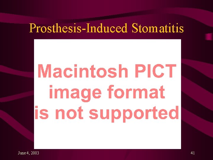 Prosthesis-Induced Stomatitis June 4, 2003 41 