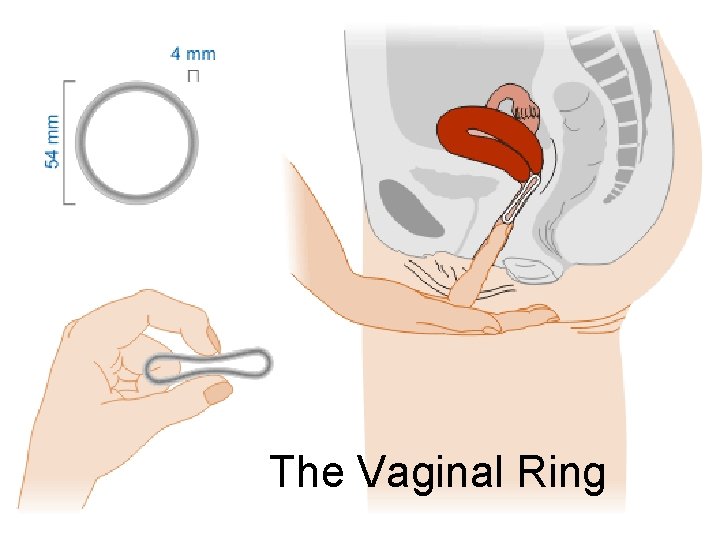 The Vaginal Ring 