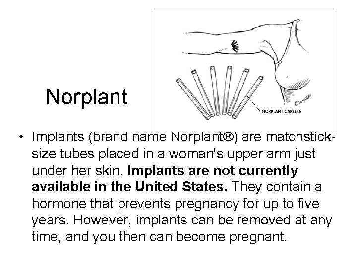 Norplant • Implants (brand name Norplant®) are matchsticksize tubes placed in a woman's upper