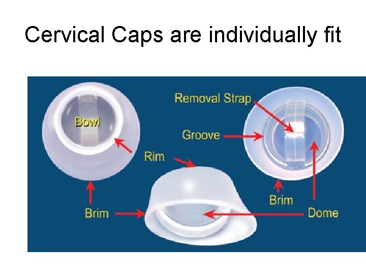 Cervical Caps are individually fit 