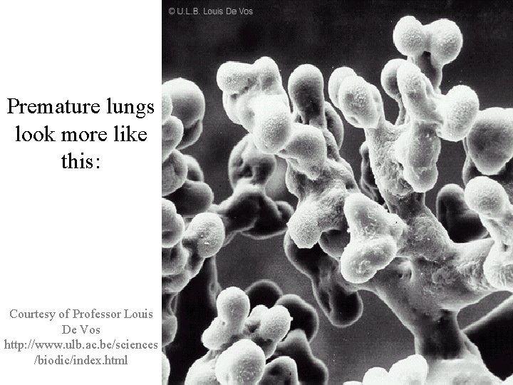 Premature lungs look more like this: Courtesy of Professor Louis De Vos http: //www.