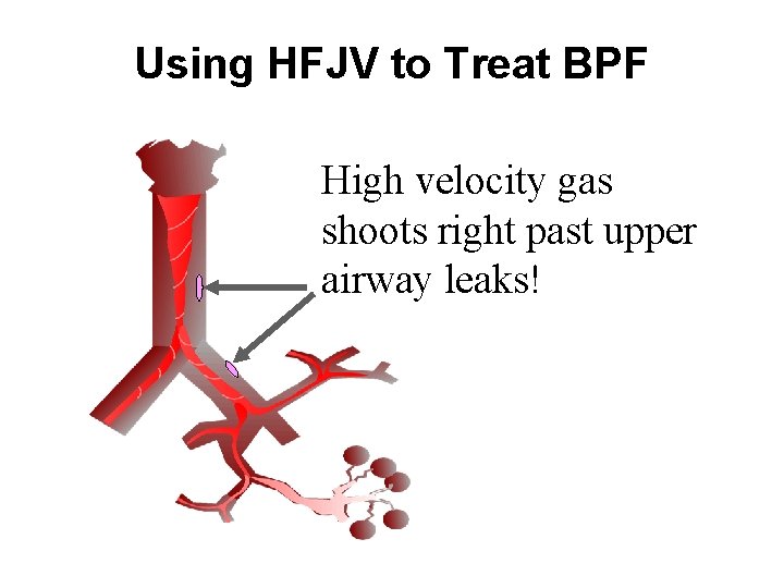 Using HFJV to Treat BPF High velocity gas shoots right past upper airway leaks! Using HFJV to Treat BPF High velocity gas shoots right past upper airway leaks!