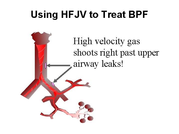 Using HFJV to Treat BPF High velocity gas shoots right past upper airway leaks!