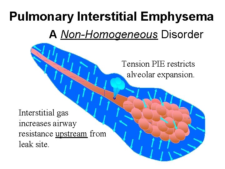 Pulmonary Interstitial Emphysema A Non-Homogeneous Disorder Tension PIE restricts alveolar expansion. Interstitial gas increases Pulmonary Interstitial Emphysema A Non-Homogeneous Disorder Tension PIE restricts alveolar expansion. Interstitial gas increases