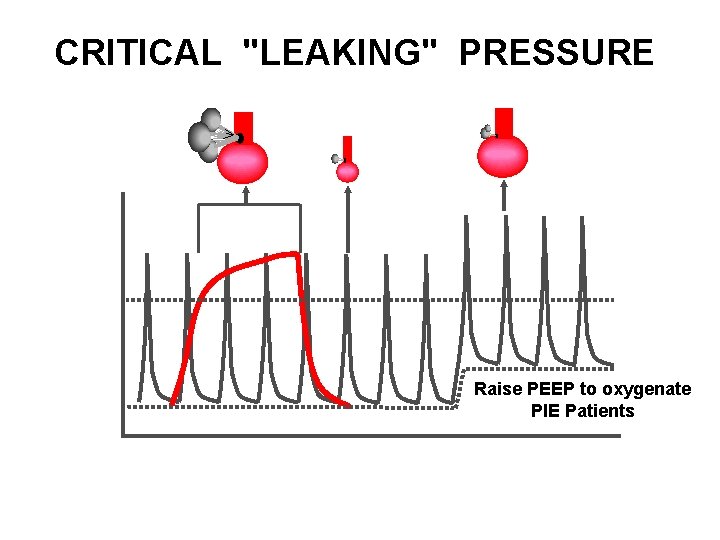 CRITICAL "LEAKING" PRESSURE cm H 2 O 30 20 15 10 Raise PEEP to