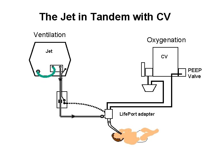 The Jet in Tandem with CV Ventilation Oxygenation Jet CV PEEP Valve Life. Port The Jet in Tandem with CV Ventilation Oxygenation Jet CV PEEP Valve Life. Port