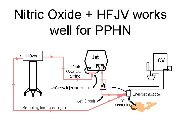 Nitric Oxide + HFJV works well for PPHN * INOvent Jet CV "T" into