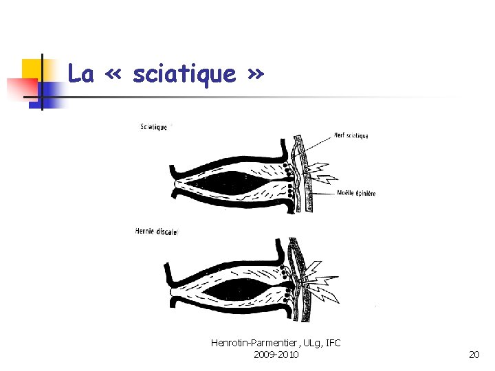 La « sciatique » Henrotin-Parmentier, ULg, IFC 2009 -2010 20 