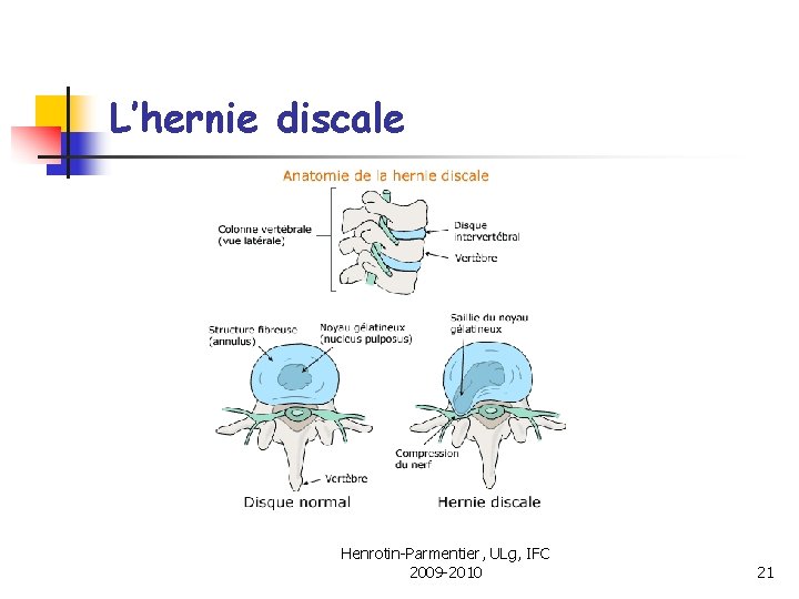 L’hernie discale Henrotin-Parmentier, ULg, IFC 2009 -2010 21 