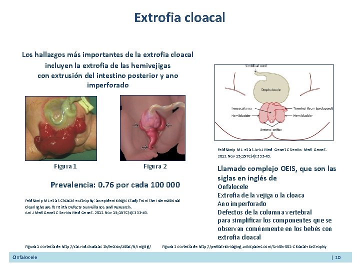 Extrofia cloacal Los hallazgos más importantes de la extrofia cloacal incluyen la extrofia de