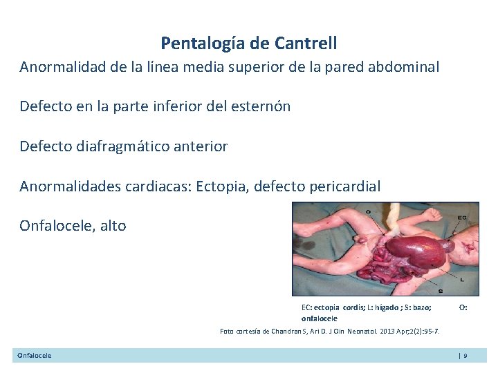 Pentalogía de Cantrell Anormalidad de la línea media superior de la pared abdominal Defecto