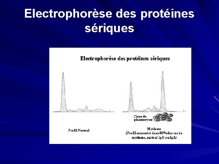 Electrophorèse des protéines sériques 