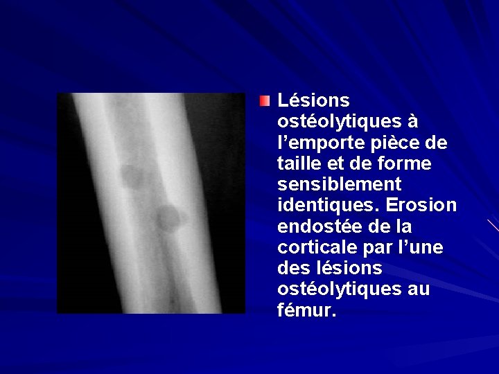 Lésions ostéolytiques à l’emporte pièce de taille et de forme sensiblement identiques. Erosion endostée