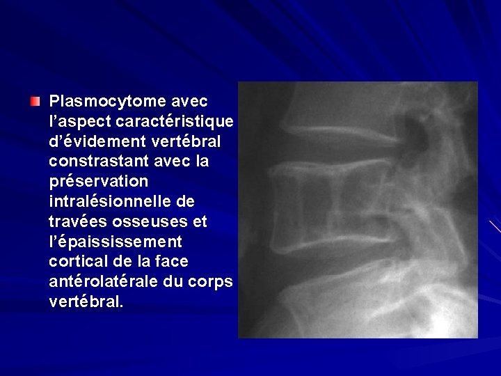 Plasmocytome avec l’aspect caractéristique d’évidement vertébral constrastant avec la préservation intralésionnelle de travées osseuses