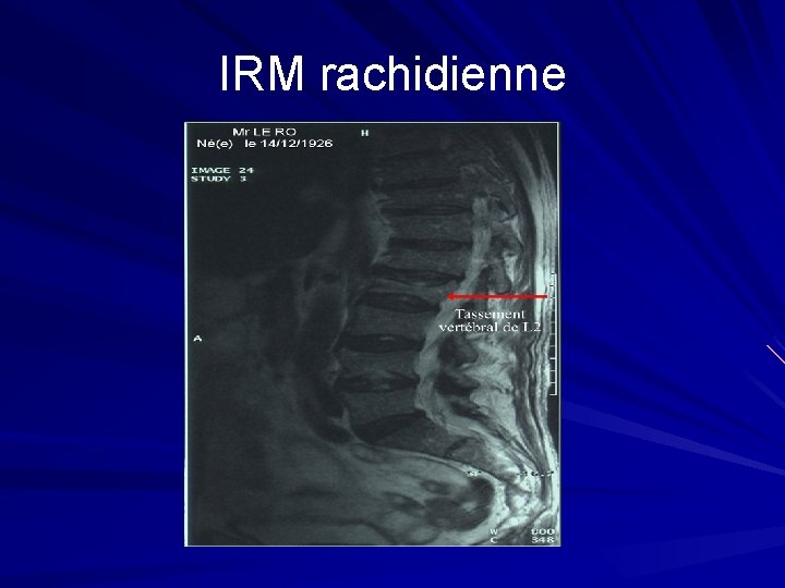 IRM rachidienne 
