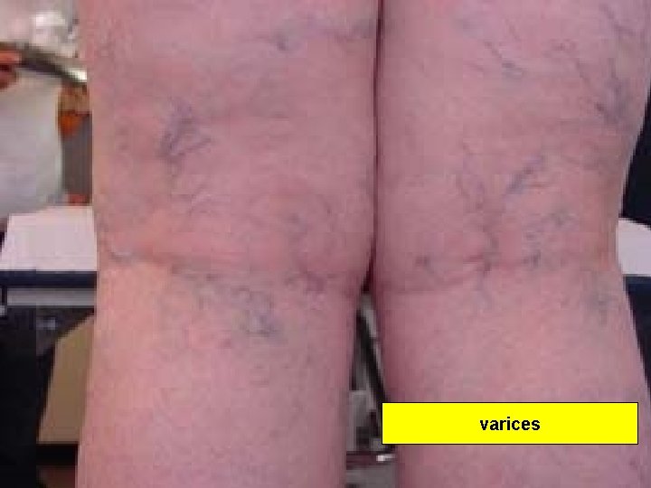 varices 