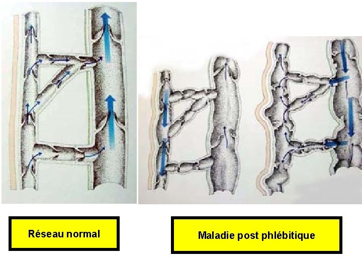 Réseau normal Maladie post phlébitique 