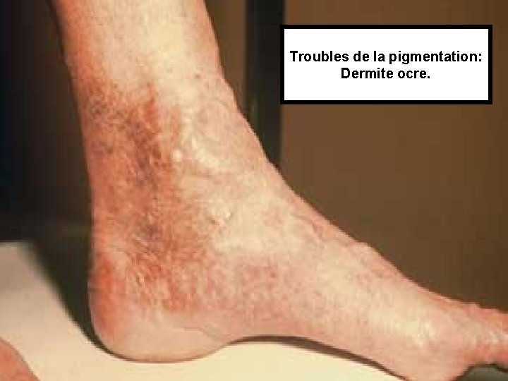 Troubles de la pigmentation: Dermite ocre. 