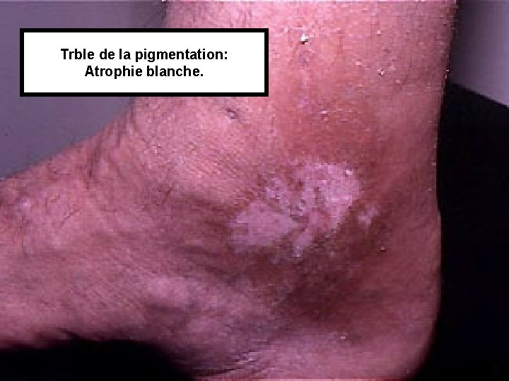 Trble de la pigmentation: Atrophie blanche. 