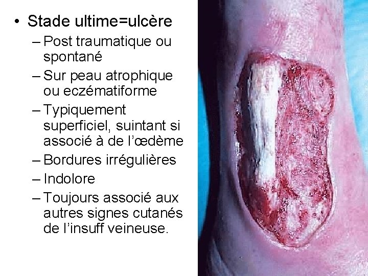  • Stade ultime=ulcère – Post traumatique ou spontané – Sur peau atrophique ou